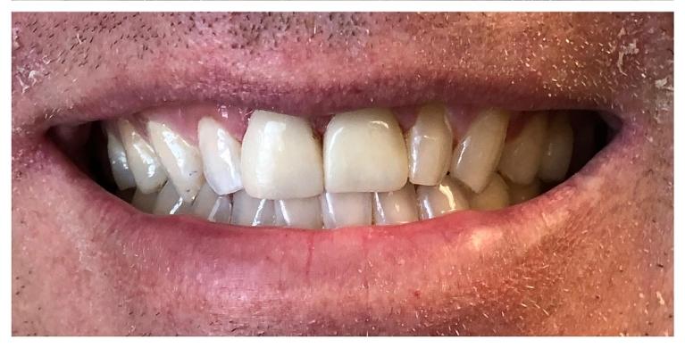 Anterior-Zirconia-Metal-free-Crowns-After-Image