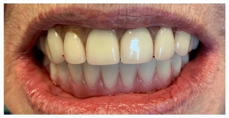 Lower-Complete-Denture-After-Remaining-Lower-Teeth-were-Extracted-After-Image