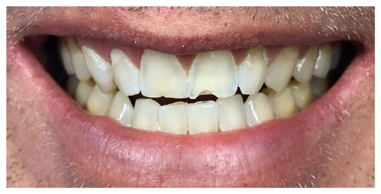 Anterior-Zirconia-Metal-free-Crowns-Before-Image